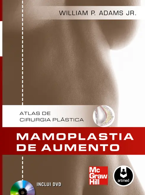 Mamoplastia de Aumento